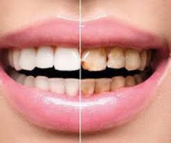 نشانه های پوسیدگی دندان چیست جواب فعالیت صفحه ۹۶ سلامت و بهداشت